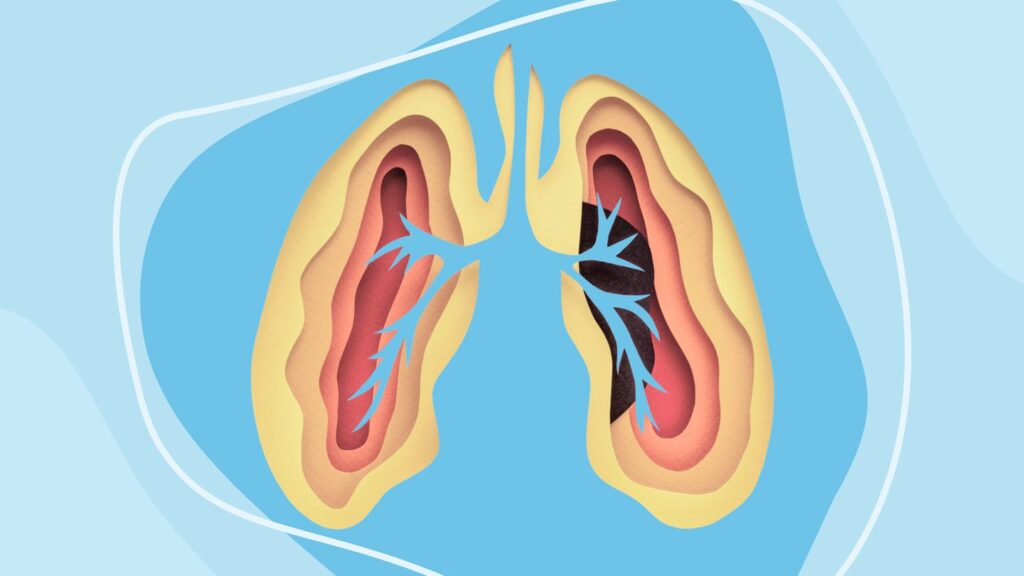 7 Myths About Lung Cancer