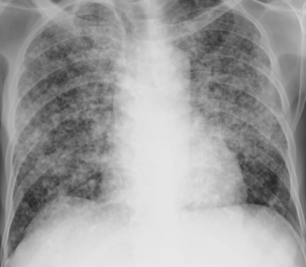 AI Deep Learning Tool Sharpens Lung Cancer Screening Accuracy