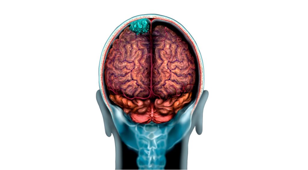 Adding Up: Plus Therapeutics Gets First Metastatic CNS Cancer Assay Insured