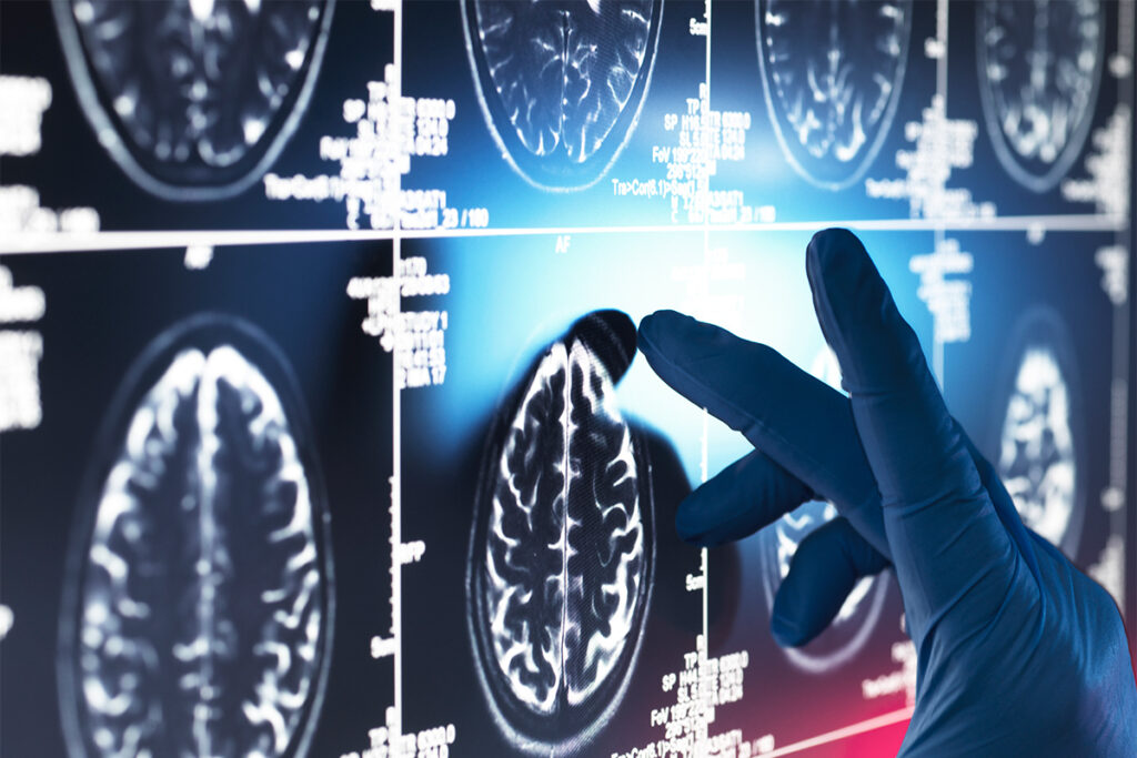 Advantage lands NIA funding to advance Alzheimer’s drug