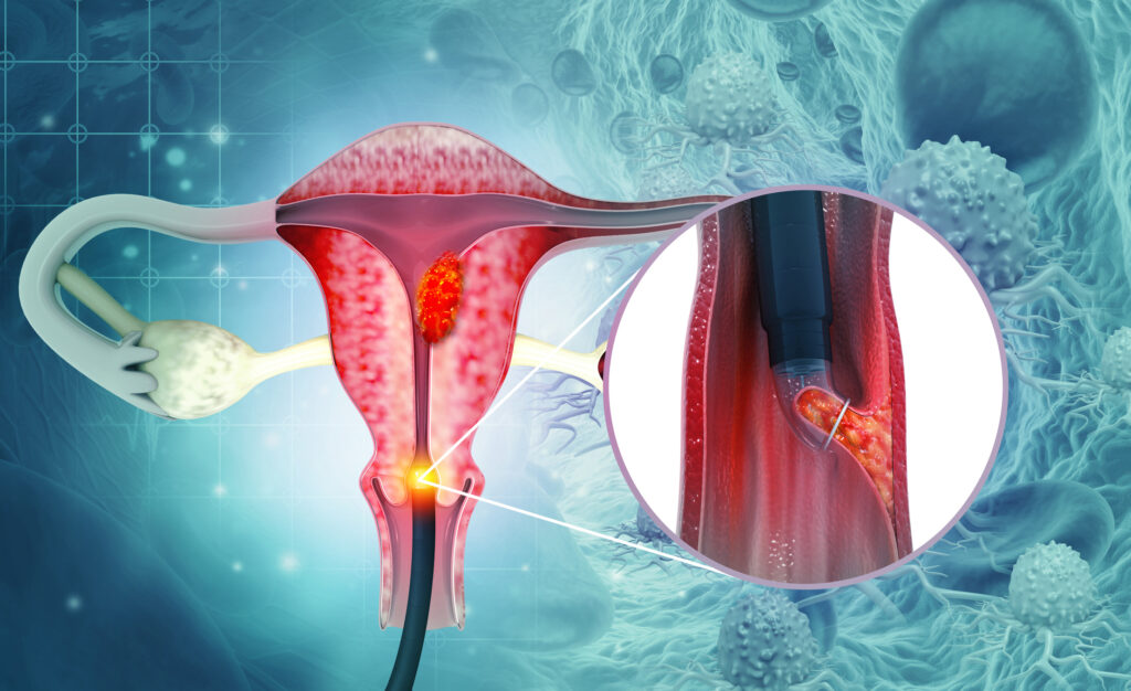 Cervical Cancer Survivors at High Risk of Developing Anal Cancer