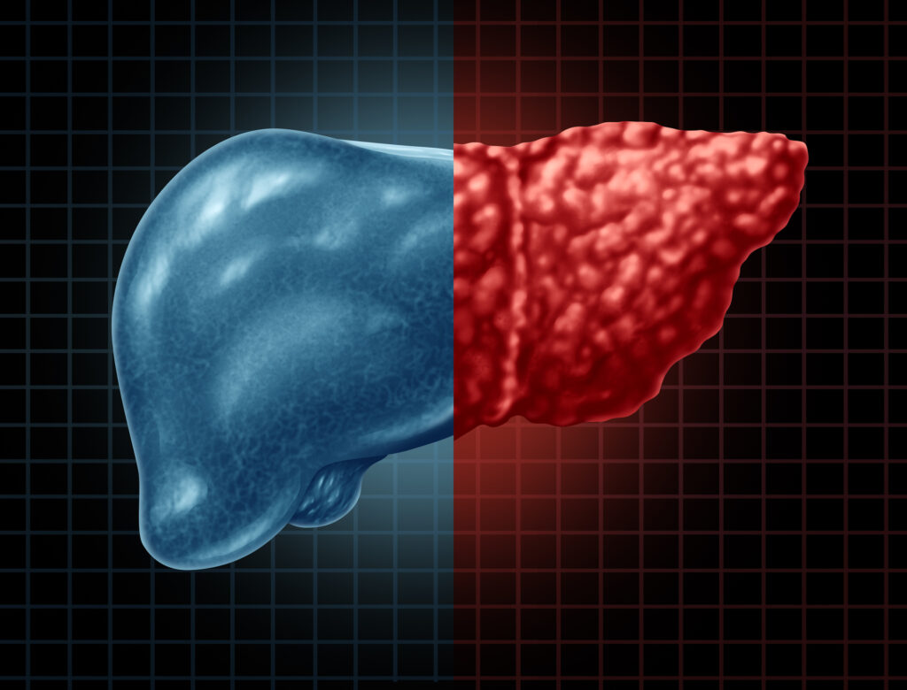 Deadliest Risk Factors of Common Liver Disease Found