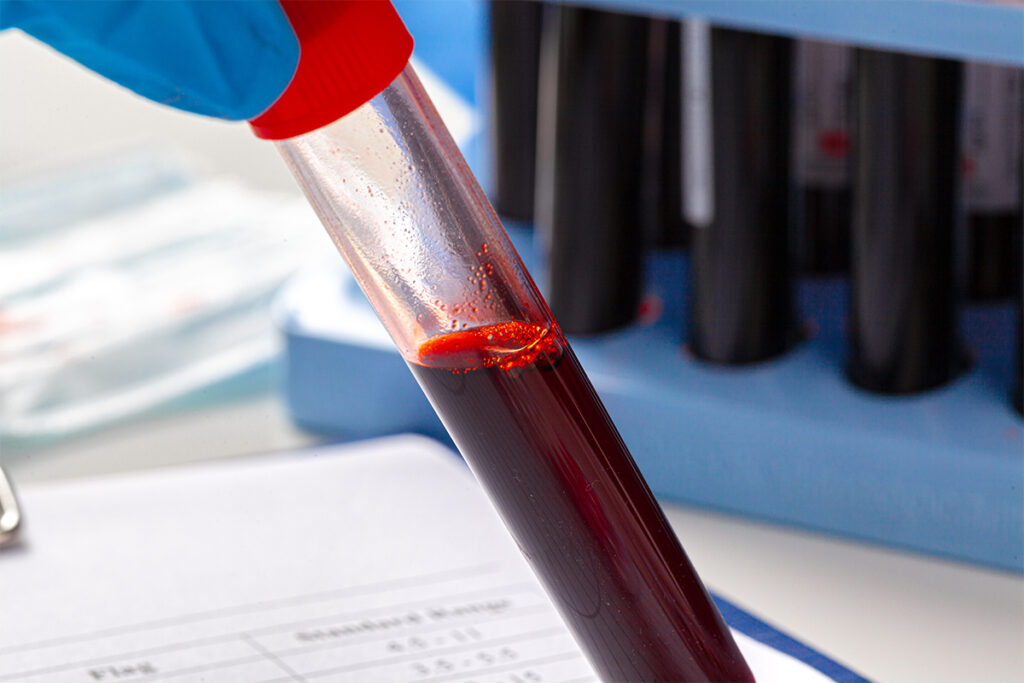 FYR lands funding to find new biomarkers for Parkinson's