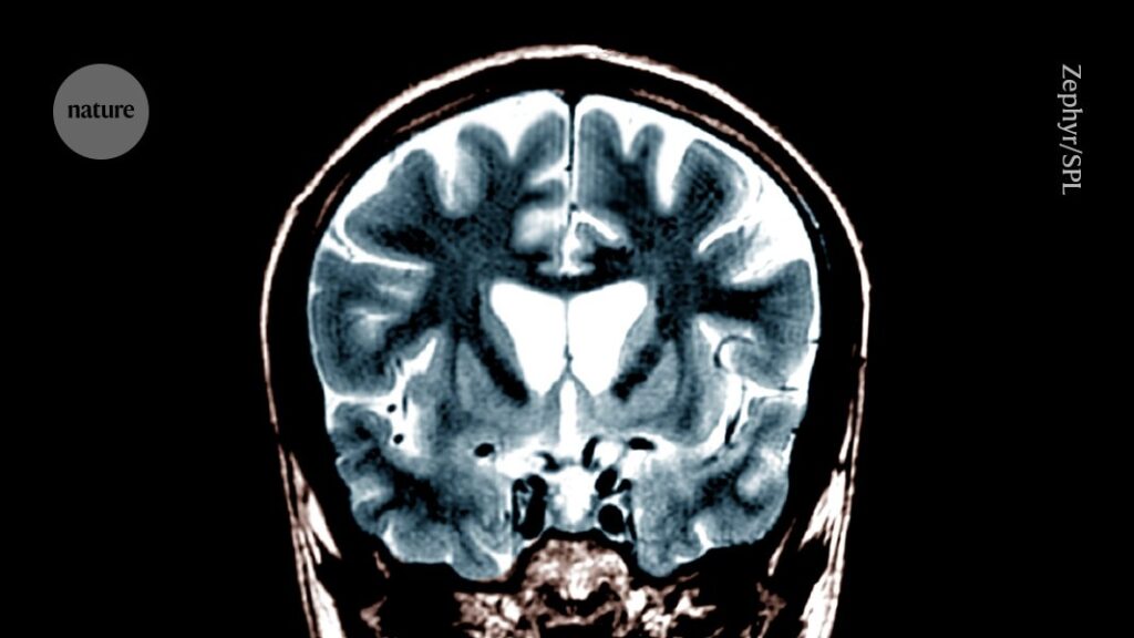 Huntington’s disease treated for first time using gene therapy