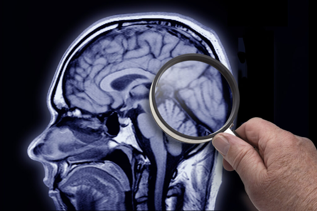 Self-Administered Tablet Test Identifies Cognitive Impairment