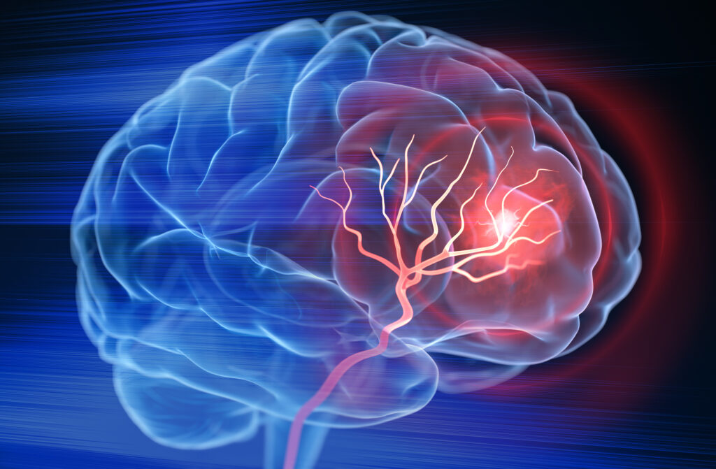 Stem Cell Transplant in Mice Makes Stroke Recovery Possible