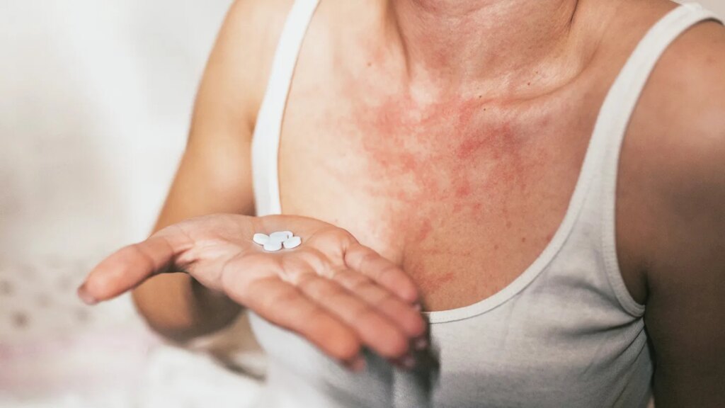 What to Do When Antihistamines Stop Working for Hives: 4 Options