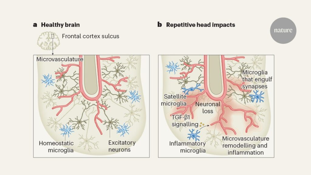 Years of hits to the head prime the brain for decline
