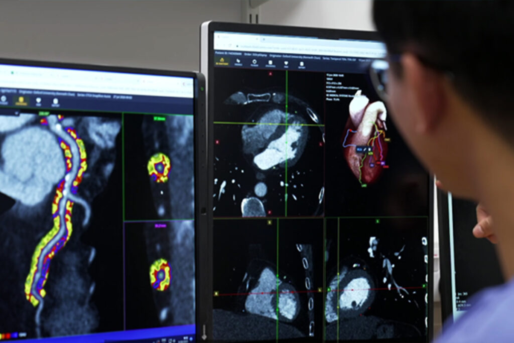 AI heart scan targets risk before plaque