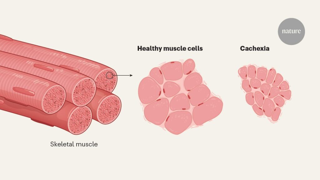 Clues to why the weight-loss condition cachexia arises when cancer occurs