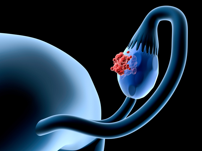 Coagulation Factor II Receptor Shows Promise as Ovarian Cancer Target Ovarian Cancer