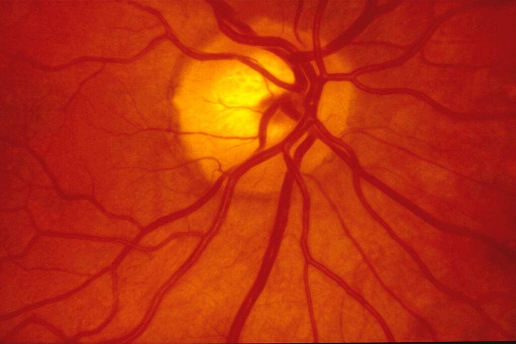 Gene therapy startup targets ‘aging itself’ to combat blinding disease