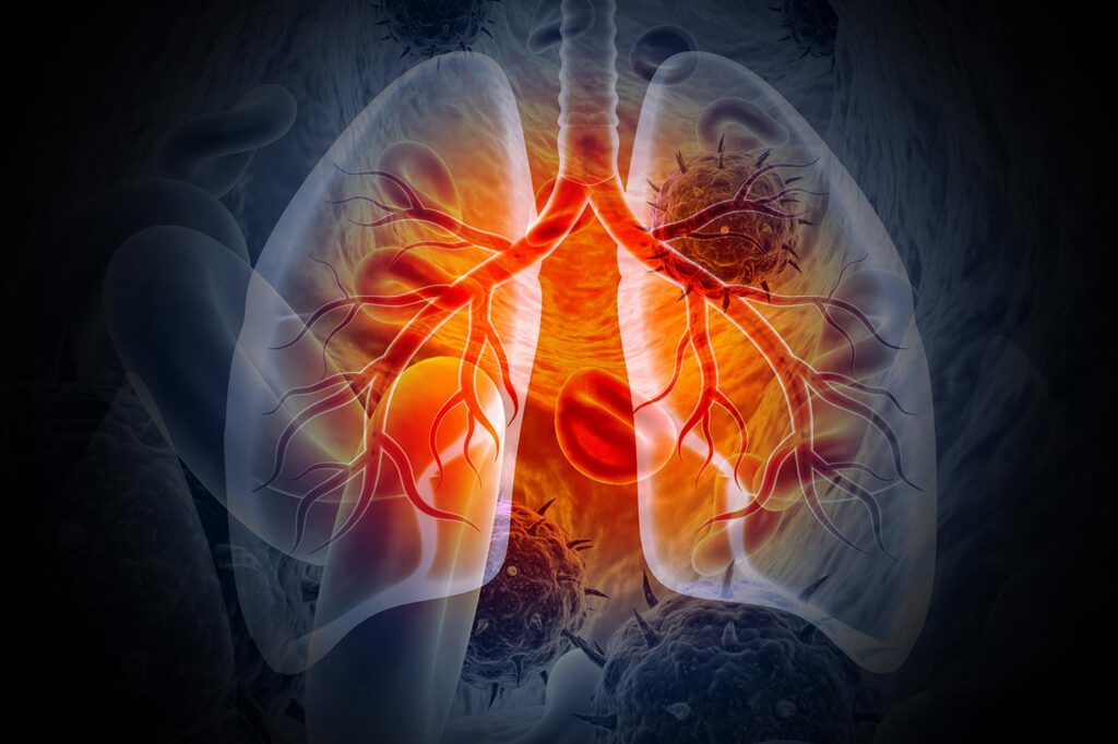 How to Find More Lung Cancers Using the EHR