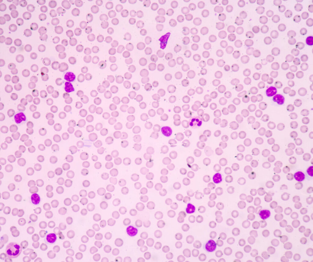 Leukemia Progression Mapped by New Multi-Omics Tool, GoT-Multi
