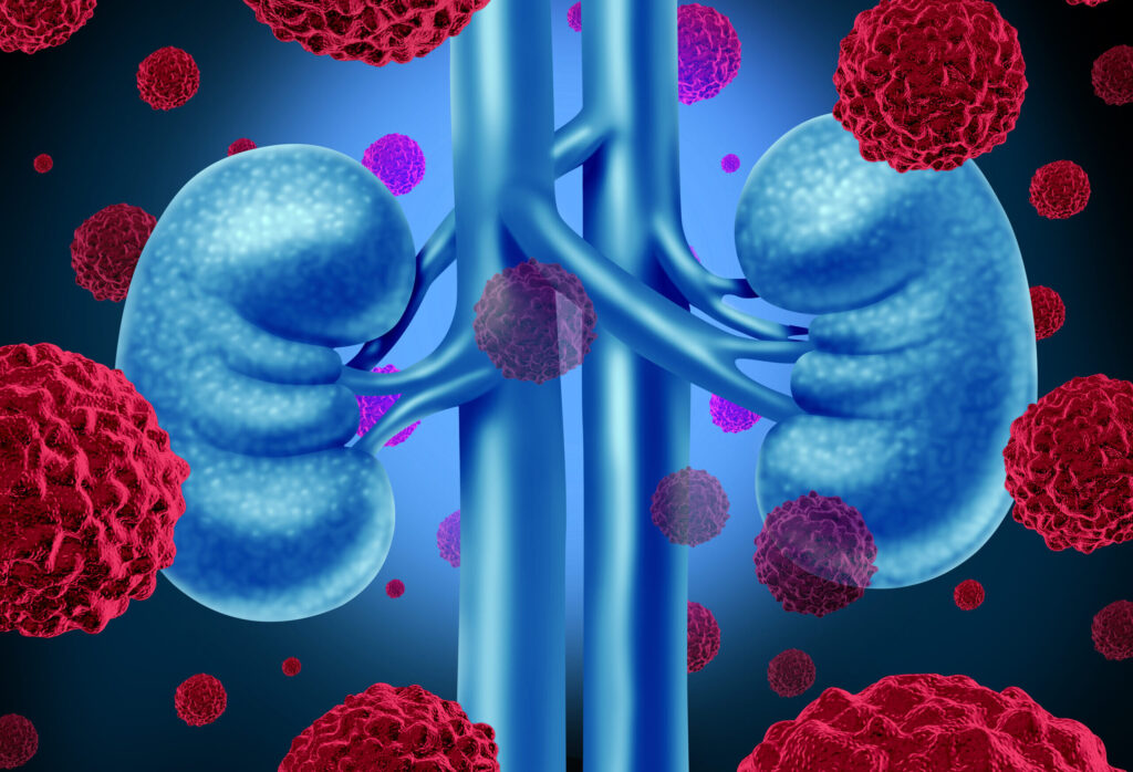New Precision Target Found in Aggressive Kidney Cancer New Precision Target Found in Aggressive Kidney Cancer