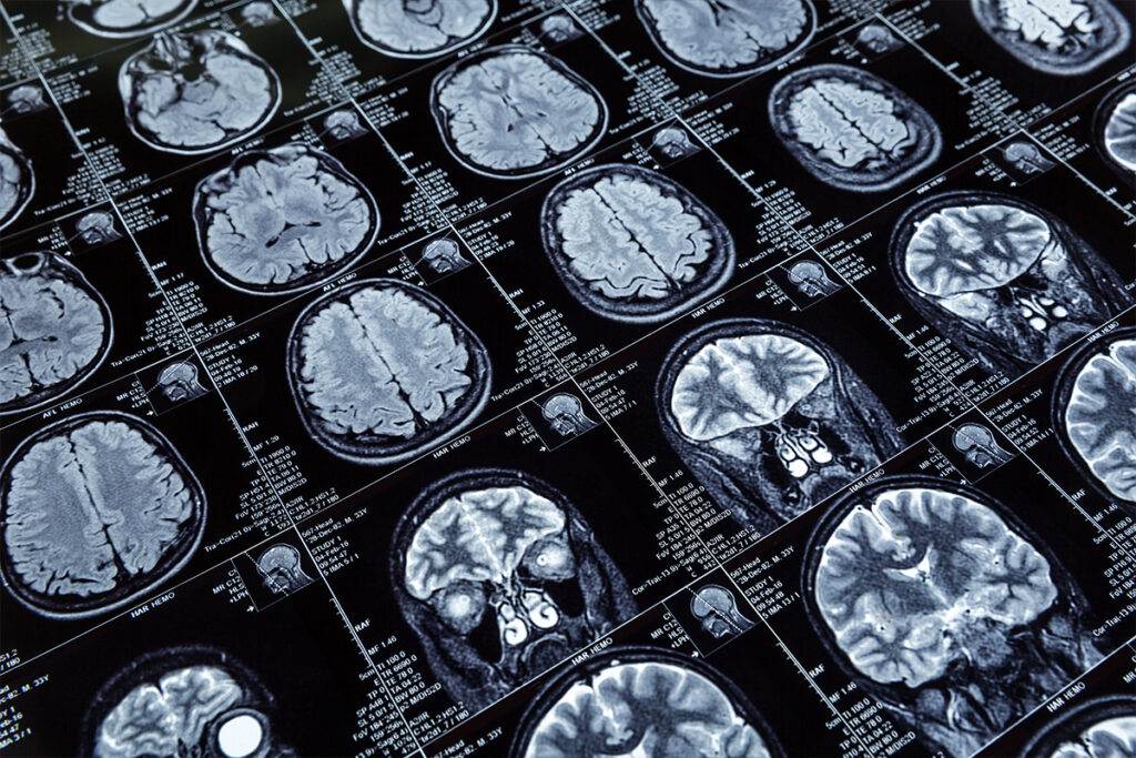 New trial data supports Alzheimer’s drug candidate’s ‘disease-modifying’ potential