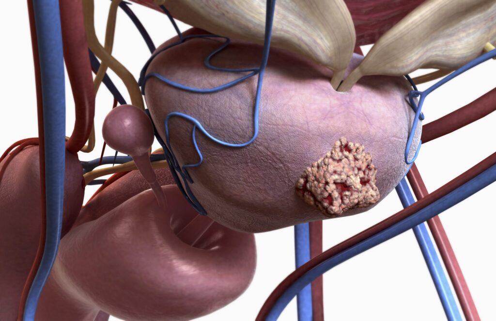 Prostate Cancer Biomarker Test First to Predict Hormone Therapy Response