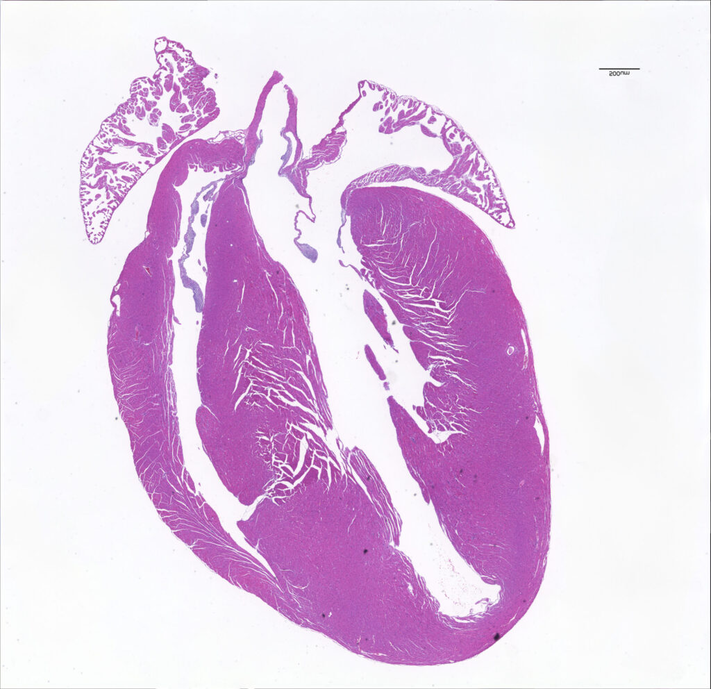 Single Nucleotide Edit Fixes Heart Muscle Disease