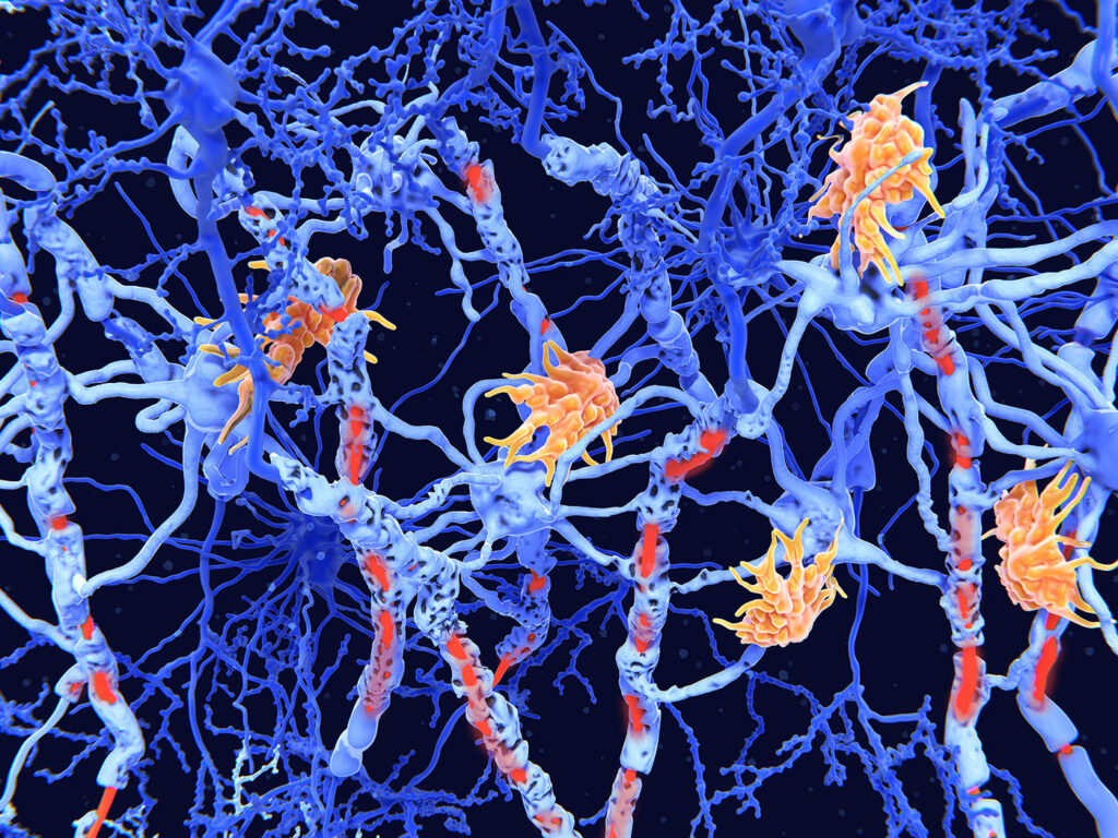 Unusual Brain Cell Type Linked to Progressive MS, Could Point to Therapeutics