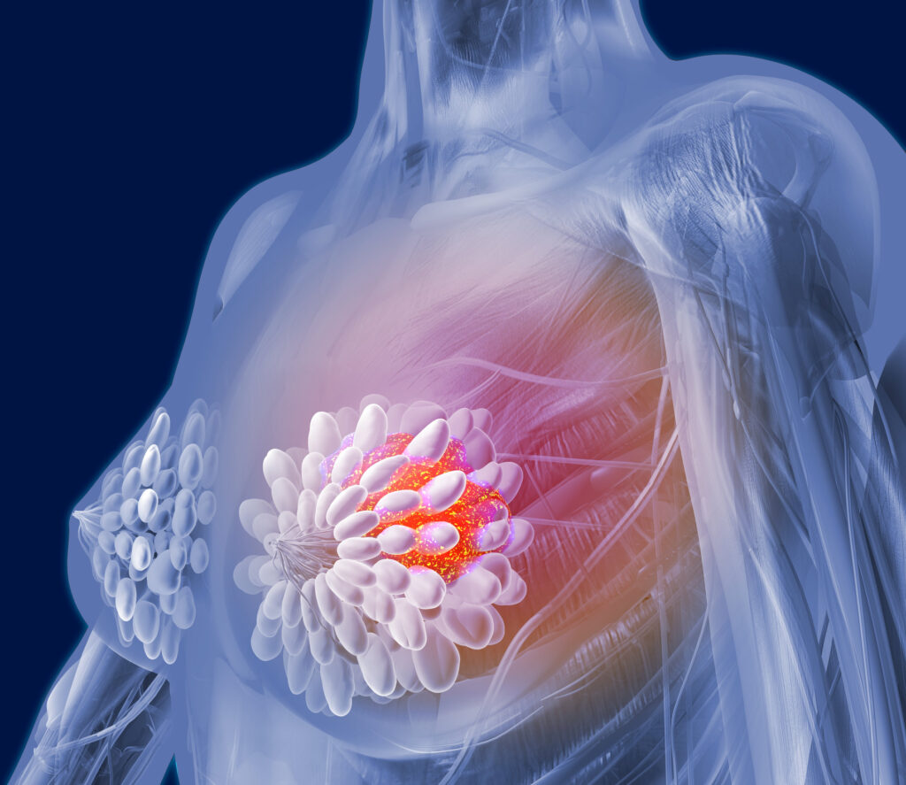 Whole Genome Sequencing Adds Significant Prognostic Value in Breast Cancer
