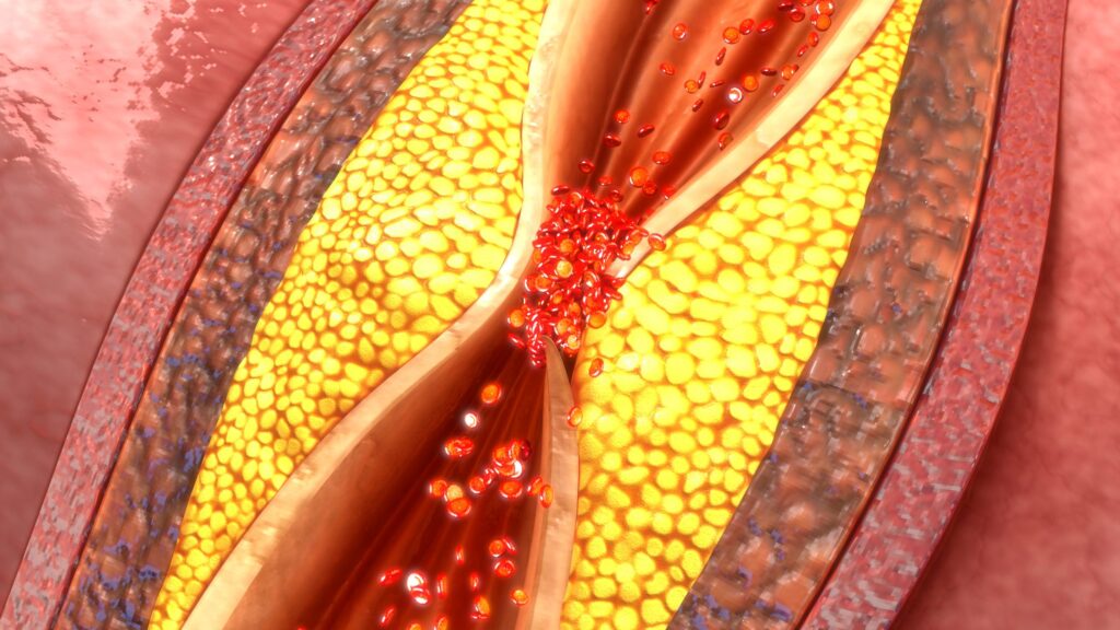 CAR T Cell Therapy for Coronary Artery Disease Shows Early Success