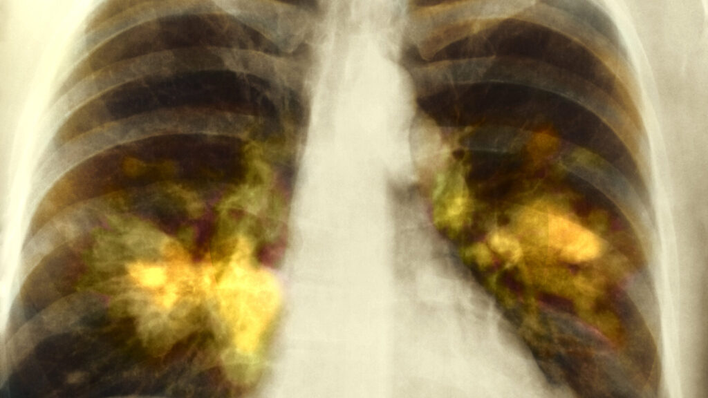 Qure.ai and Microsoft Collaborate on Lung Cancer Detection
