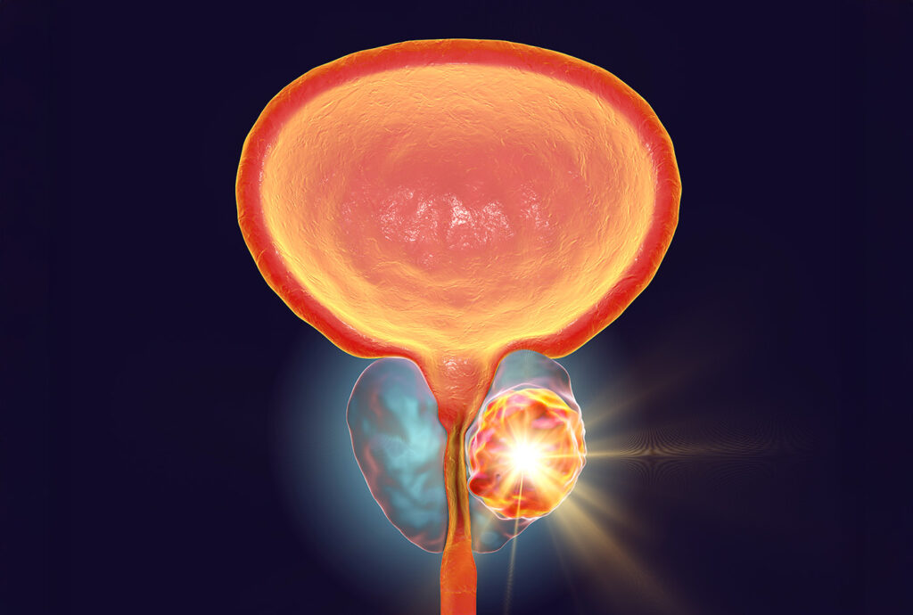 Hormone Therapy Unnecessary for Most Men Needing Post-Prostatectomy Radiotherapy Thyroid Hormone Receptor TRβ Identified as New Target for Prostate Cancer Treatment