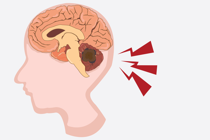Treatment Intensity for Many Medulloblastoma Patients Reduced at St. Jude Medulloblastoma