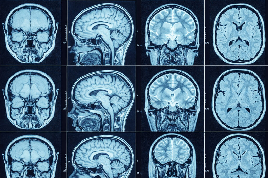 Anavex pushes for Alzheimer’s drug re-evaluation