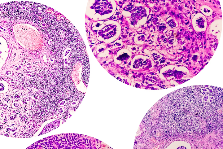 Astrin Launches Blood-Based Early Breast Cancer Detection Test College of four photomicrograph showing Invasive ductal carcinoma (IDC) grade-II, most common form of breast cancer. Lymphovascular invasion: Present