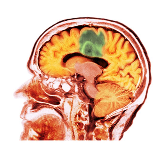 Fertility-Linked Gene Helps Glioblastoma Cells Resist Chemotherapy Glioblastoma brain cancer, CT scan