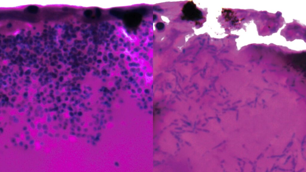 First Gene Expression Study of Candida auris Identifies New Drug Targets