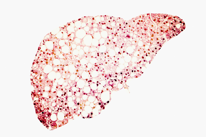 High-Fat Diet Triggers Hepatocyte Dedifferentiation and Cancer Risk Fatty liver
