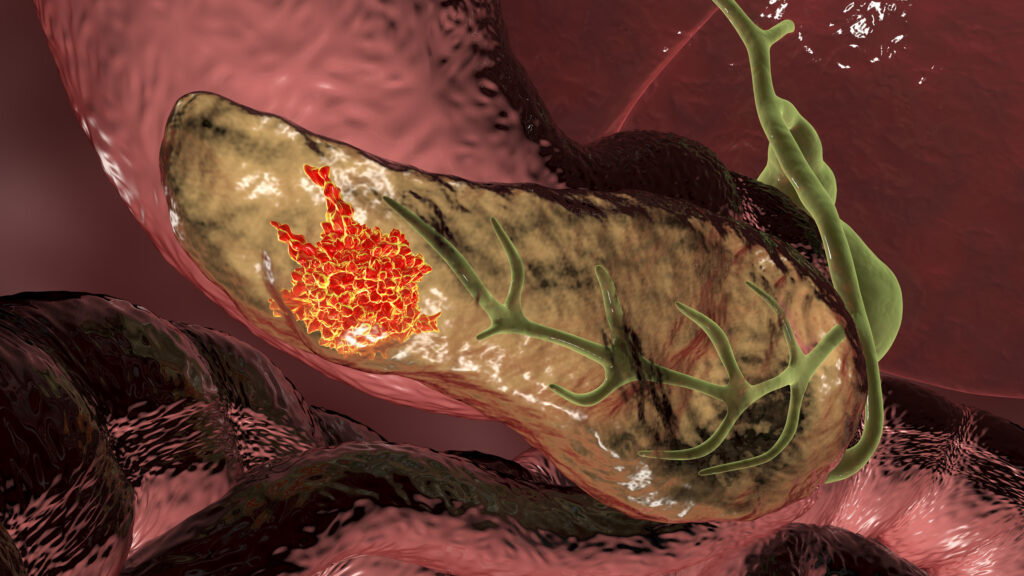 Pancreatic Cancer Drug Treatments Improved by Targeting Collagen Signaling