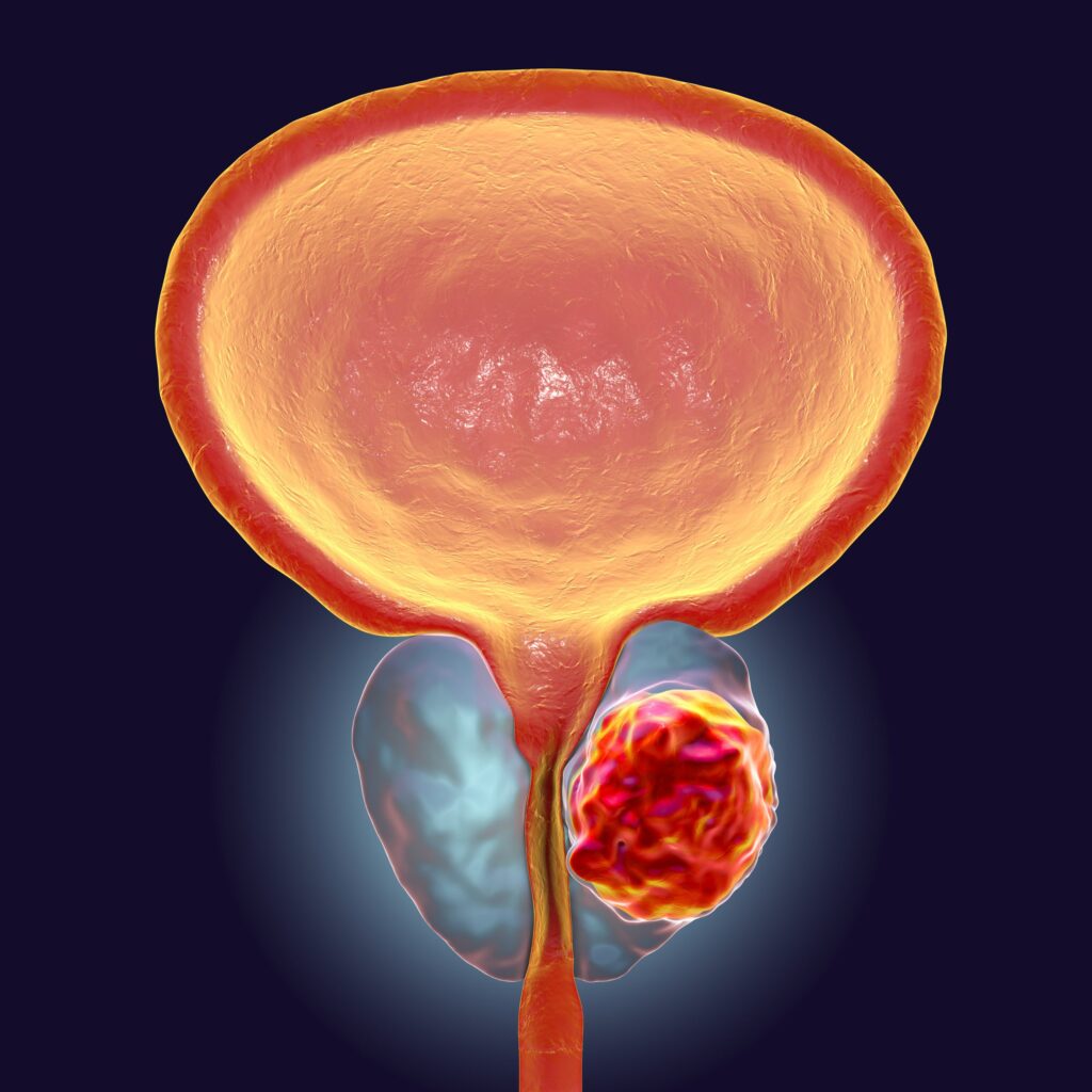 Beyond PSA Cutoffs: Long-Term Model Predicts Prostate Cancer Death Risk