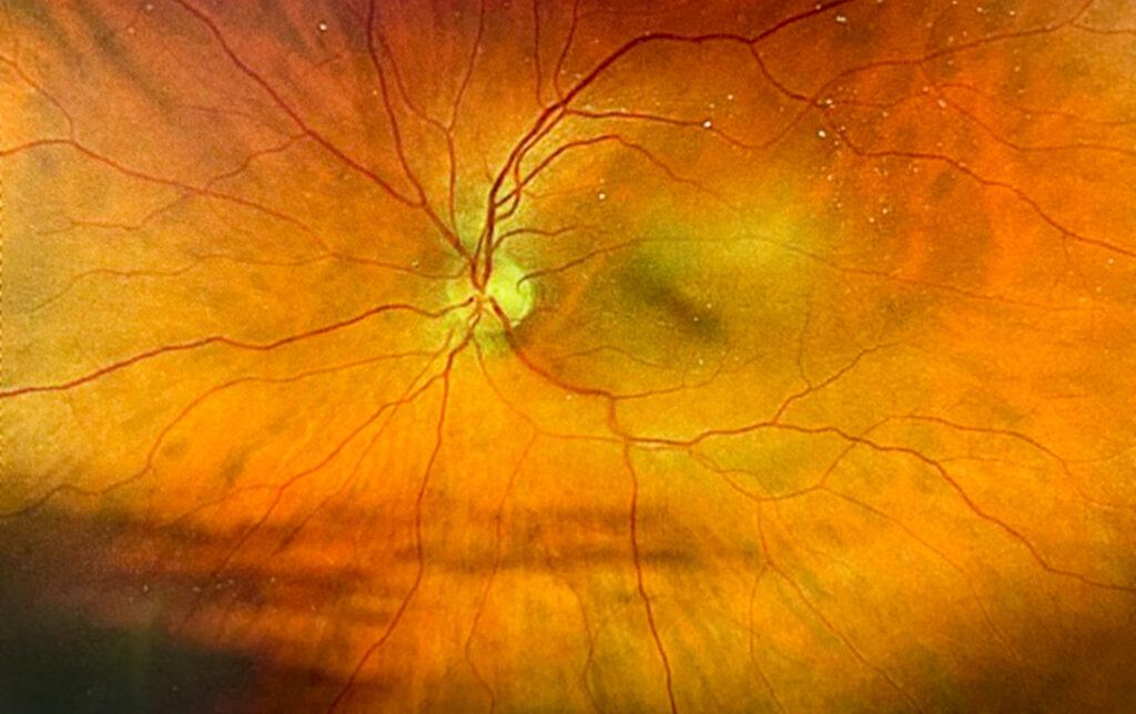 Manufacturing Science Matters in Biosimilar Retinal Biotherapeutics An image of a human retina taken during an eye exam