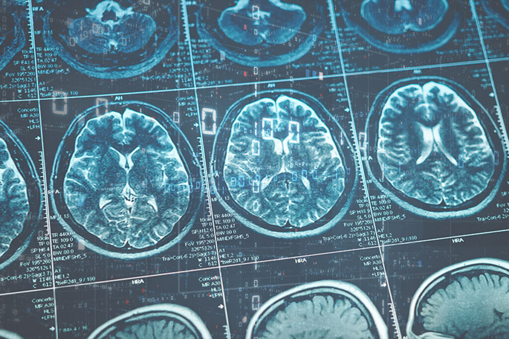 New data suggest enzyme modulator may slow Parkinson’s