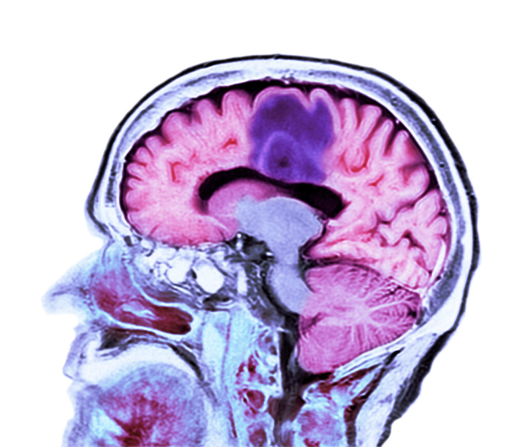 Oligodendrocytes Emerge as Drivers of Glioblastoma Invasion Oligodendrocytes Emerge as Drivers of Glioblastoma Invasion