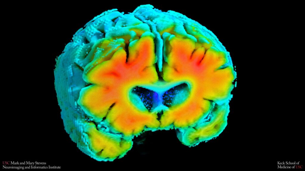 Brain Blood Flow Markers Detect Early Signs of Alzheimer’s Brain Blood Flow Markers Detect Early Signs of Alzheimer’s