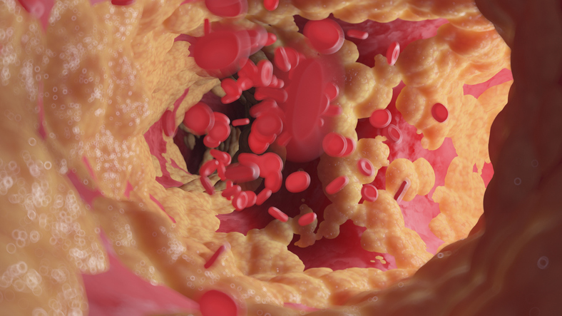 HeFH Base Editor Shows Promise in Chinese Clinical Trial Fatty human artery, illustration