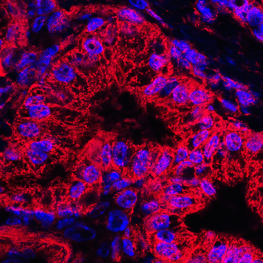 KRAS Inhibitors Intercept Pancreatic Cancer Before It Develops in Mice