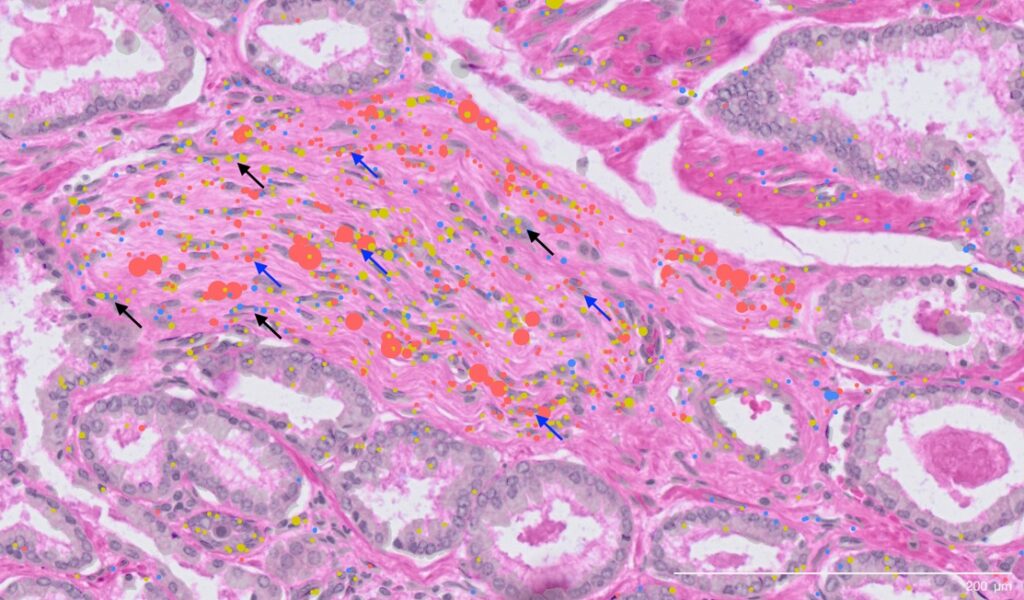 The newly discovered cell type shown clustering around a prostate cancer nerve bundle.