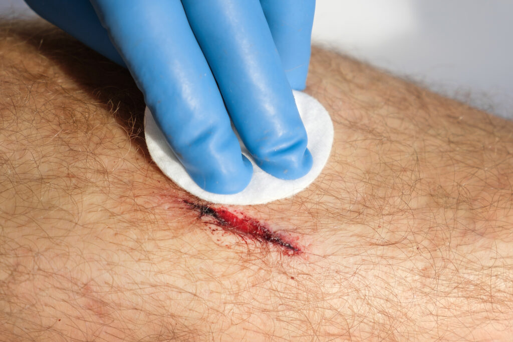 Smart Wound Dressing Provides Targeted Antibiotic Release