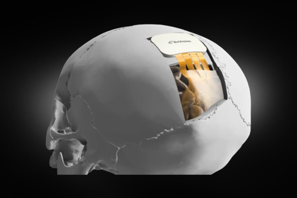 Startup targets 'untreatable blindness' with bionic eye system