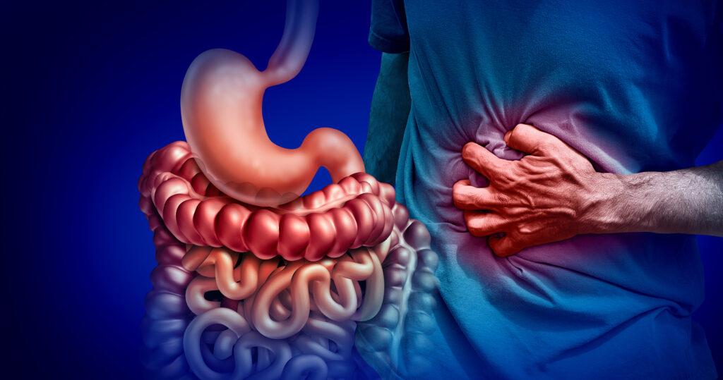 Vitamin D May Help Restore Immune Tolerance in Inflammatory Bowel Disease Vitamin D May Help Restore Immune Tolerance in Inflammatory Bowel Disease